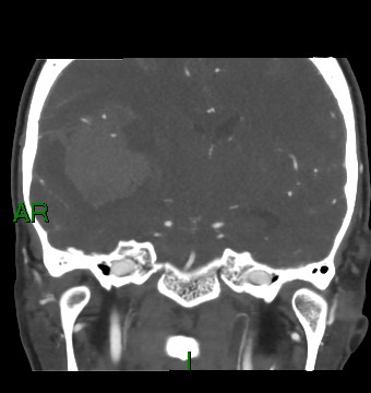 File:Aneurysmal subarachnoid hemorrhage with intra-axial extension (Radiopaedia 84371-99732 C 51).jpg