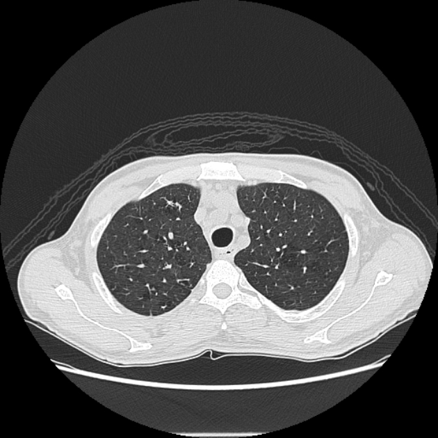 Angioinvasive aspergellosis (Radiopaedia 66995-76315 Axial lung window 9).jpg