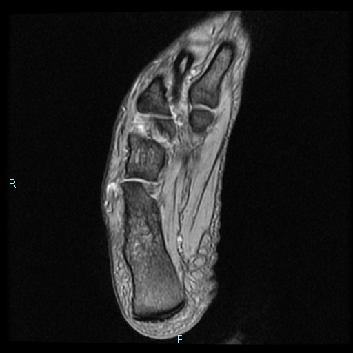 Ankle ganglion cyst (Radiopaedia 62809-71162 Axial Gradient Echo 16).jpg