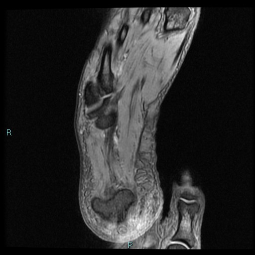 Ankle ganglion cyst (Radiopaedia 62809-71162 Axial Gradient Echo 4).jpg