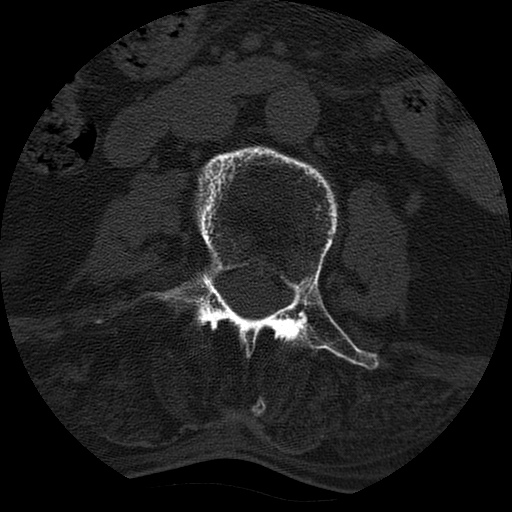 File:Ankylosing spondylitis complicated by fracture-dislocation (Radiopaedia 33583-34674 Axial non-contrast 74).jpg