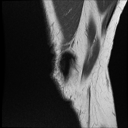 Anomalous insertion of the medial meniscus (Radiopaedia 77559-89721 Sagittal PD 48).jpg