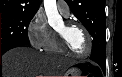 Anomalous left coronary artery from the pulmonary artery (ALCAPA) (Radiopaedia 70148-80181 B 122).jpg