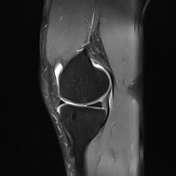 File:Anterior cruciate ligament full thickness tear (Radiopaedia 66268-75467 Sagittal PD fat sat 8).jpg