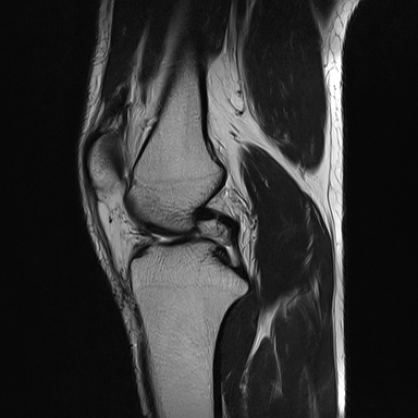 File:Anterior cruciate ligament full thickness tear (Radiopaedia 66268-75467 Sagittal T2 11).jpg