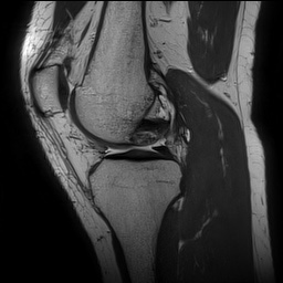 Anterior cruciate ligament rupture and posteromedial corner injury (Radiopaedia 67338-76723 Sagittal PD 70).jpg
