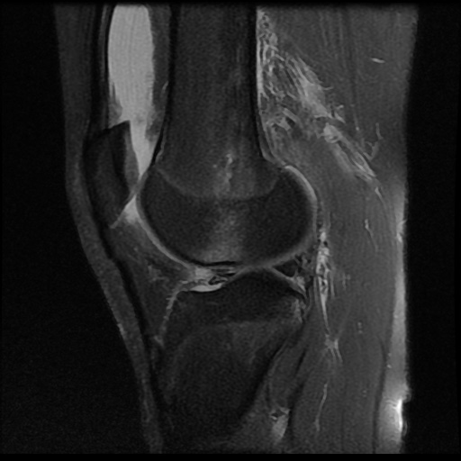 File:Anterior cruciate ligament tear (Radiopaedia 61500-69462 Sagittal PD fat sat 13).jpg