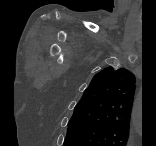 File:Anterior glenohumeral dislocation with Hill-Sachs lesion (Radiopaedia 62877-71249 Coronal bone window 12).jpg