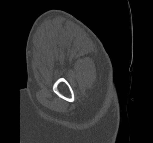 Anterior glenohumeral dislocation with Hill-Sachs lesion (Radiopaedia 62877-71249 Sagittal bone window 15).jpg