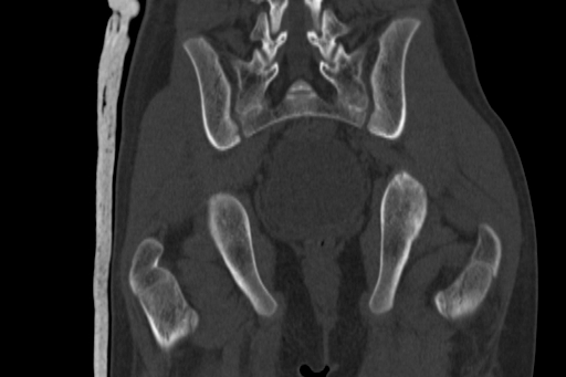 Anterior inferior iliac spine avulsion injury (Radiopaedia 88666-105376 Coronal bone window 48).jpg