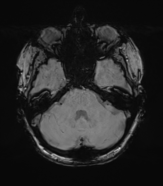 File:Anterior temporal lobe perivascular space (Radiopaedia 40946-43650 Axial SWI 22).png