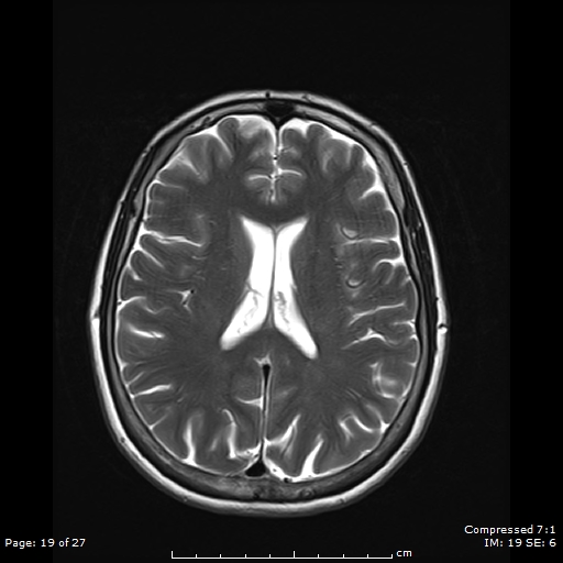 File:Anterior temporal lobe perivascular space (Radiopaedia 88283-104914 Axial T2 19).jpg