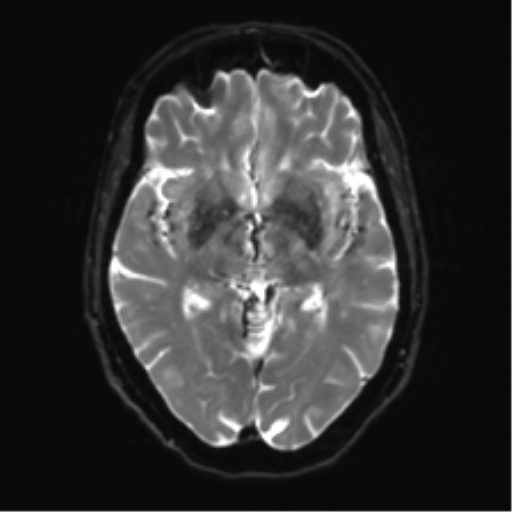 File:Anterior temporal pole cysts (Radiopaedia 46629-51102 Axial DWI 13).png