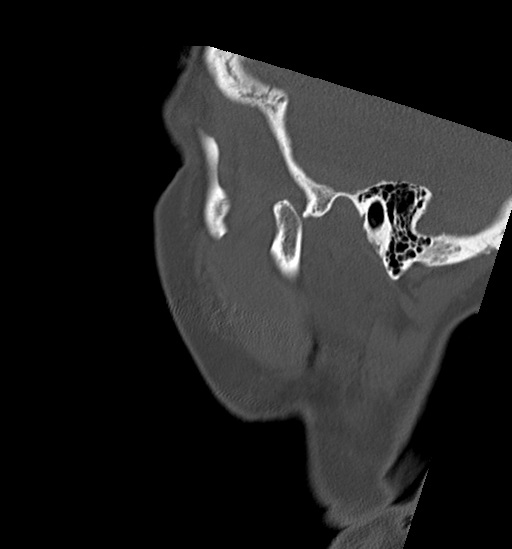 Anterior temporomandibular joint dislocation (Radiopaedia 59430-66784 B 57).jpg