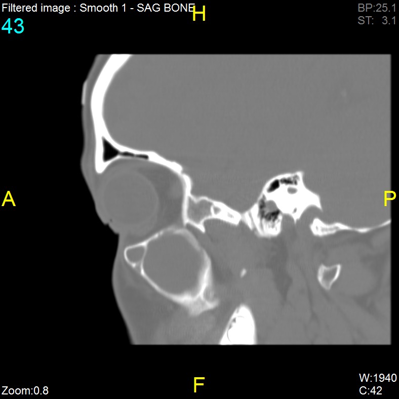 Antrochoanal polyp (Radiopaedia 65101-74094 Sagittal bone window 43).jpg