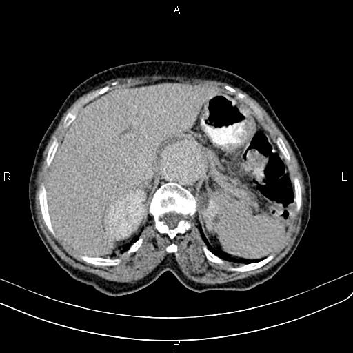 Aortic aneurysm and Lemmel syndrome (Radiopaedia 86499-102554 Axial C+ delayed 19).jpg
