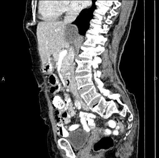 Aortic aneurysm and Lemmel syndrome (Radiopaedia 86499-102554 D 41).jpg