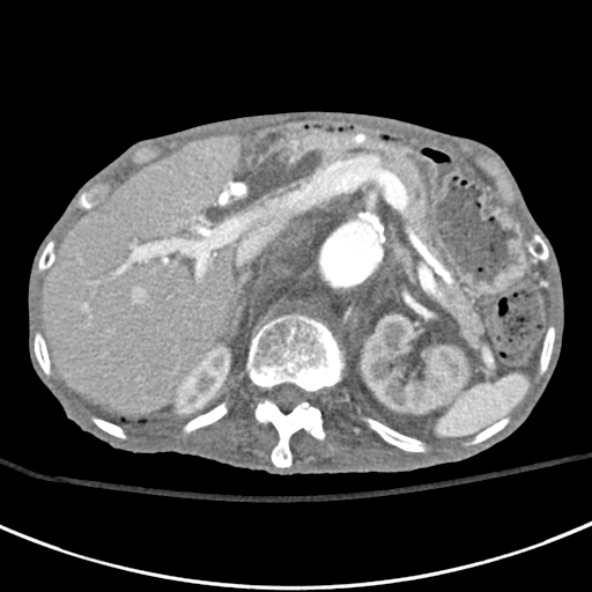 File:Aortic aneurysm with spinal destruction (Radiopaedia 42301-45410 A 26).jpg