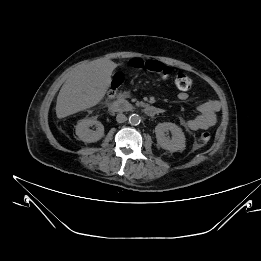 Aortic arch aneurysm (Radiopaedia 84109-99365 Axial non-contrast 352).jpg