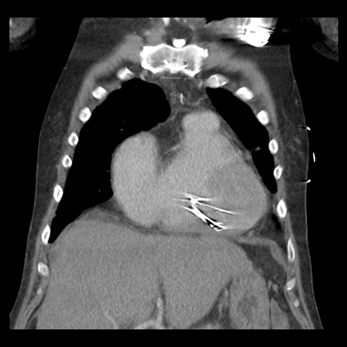 Aortic arch graft infection (FDG PET-CT) (Radiopaedia 71975-82437 Coronal 19).jpg