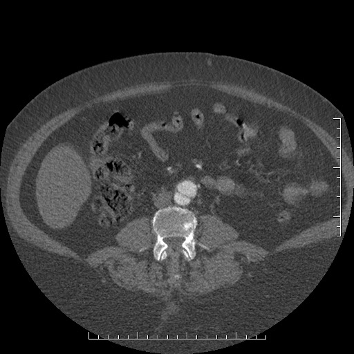 File:Aortic dissection- Stanford A (Radiopaedia 35729-37268 C 24).jpg