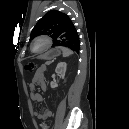 File:Aortic dissection- Stanford A (Radiopaedia 37759-39664 Sagittal C+ delayed 35).png