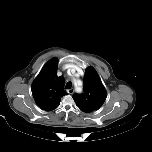 Aortic dissection- Stanford type A (Radiopaedia 22085-22085 A 13).jpg