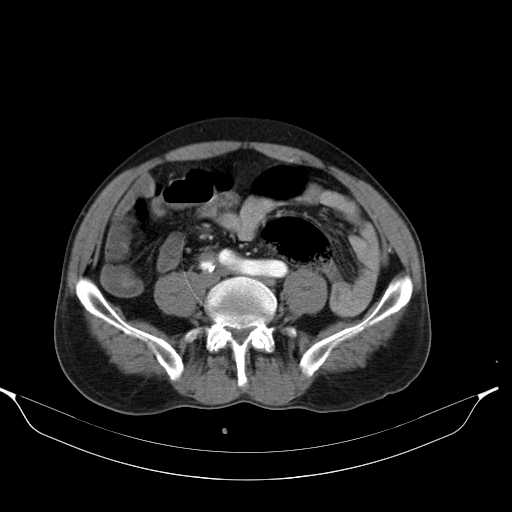 Aortic dissection- Stanford type A (Radiopaedia 22085-22085 A 62).jpg