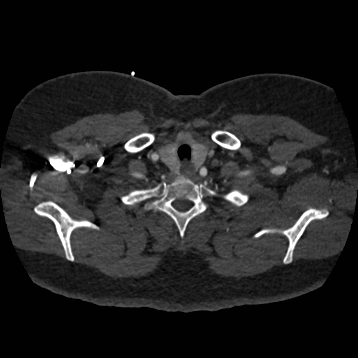 File:Aortic dissection (Radiopaedia 57969-64959 A 29).jpg