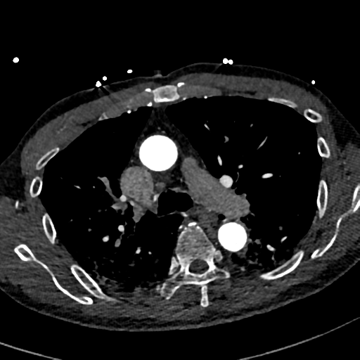 File:Aortic dissection - DeBakey type II (Radiopaedia 64302-73082 A 34).png