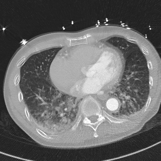 Aortic dissection - DeBakey type II (Radiopaedia 64302-73082 Axial lung window 42).png