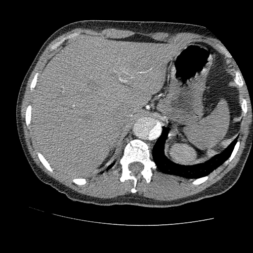 File:Aortic dissection - Stanford A -DeBakey I (Radiopaedia 28339-28587 B 101).jpg