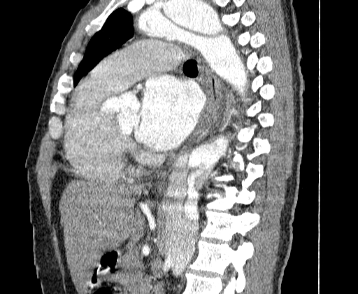 Aortic dissection - Stanford A -DeBakey I (Radiopaedia 28339-28587 C 39).jpg