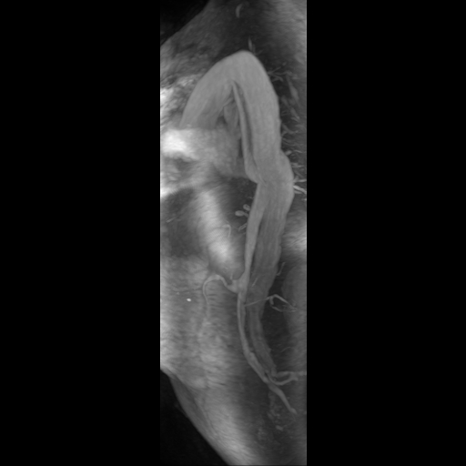 File:Aortic dissection - Stanford A - DeBakey I (Radiopaedia 23469-23551 D 6).jpg
