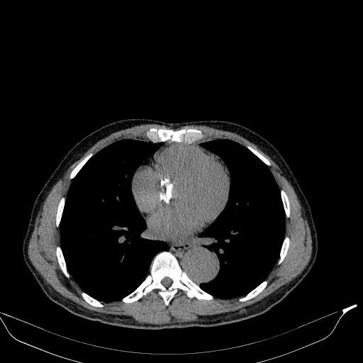 File:Aortic dissection - Stanford type A (Radiopaedia 83418-98500 Axial non-contrast 26).jpg