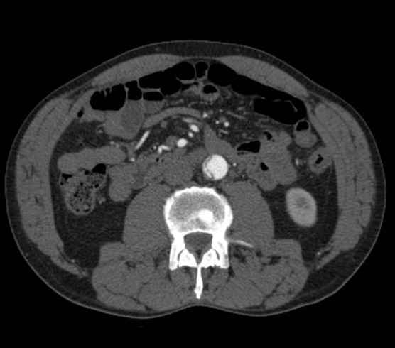 Aortic dissection - Stanford type B (Radiopaedia 73648-84437 A 167).jpg