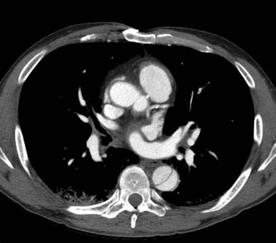 Aortic dissection - Stanford type B (Radiopaedia 73648-84437 A 55).jpg