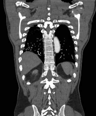 File:Aortic dissection - Stanford type B (Radiopaedia 73648-84437 B 96).jpg