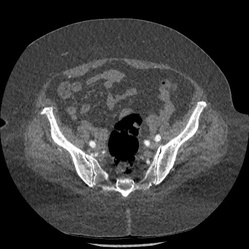 Aortic dissection - Stanford type B (Radiopaedia 88281-104910 A 145).jpg