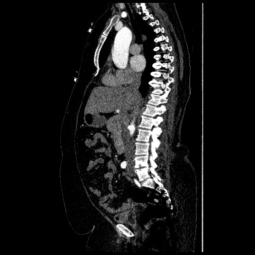 File:Aortic dissection - Stanford type B (Radiopaedia 88281-104910 C 34).jpg