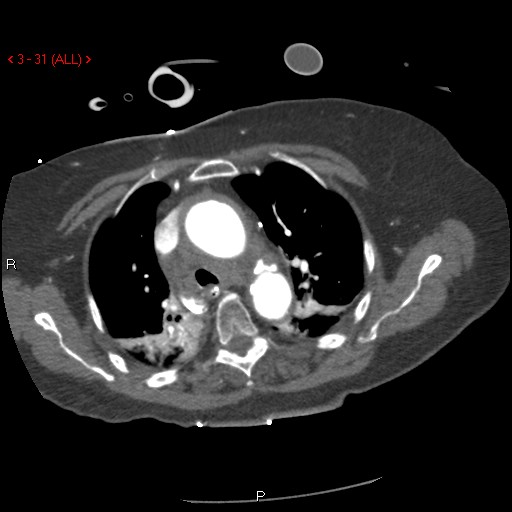 Aortic intramural hematoma (Radiopaedia 27746-28001 A 31).jpg