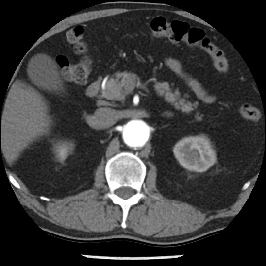 Aortic intramural hematoma (type B) (Radiopaedia 79323-92387 B 63).jpg
