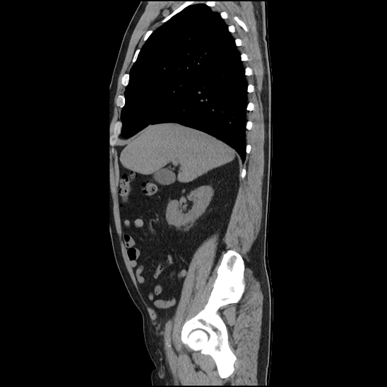 File:Aortic intramural hematoma (type B) (Radiopaedia 79323-92387 G 11).jpg