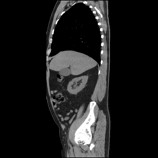 File:Aortic intramural hematoma (type B) (Radiopaedia 79323-92387 G 9).jpg