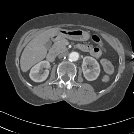 Aortic intramural hematoma from penetrating atherosclerotic ulcer (Radiopaedia 31137-31836 A 99).jpg