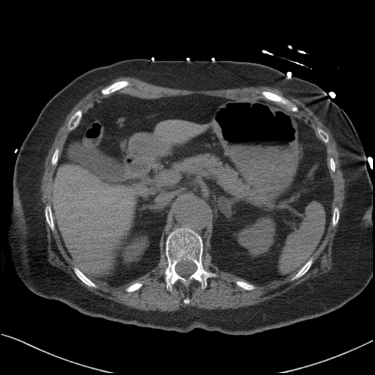 Aortic intramural hematoma with dissection and intramural blood pool (Radiopaedia 77373-89491 Axial non-contrast 101).jpg
