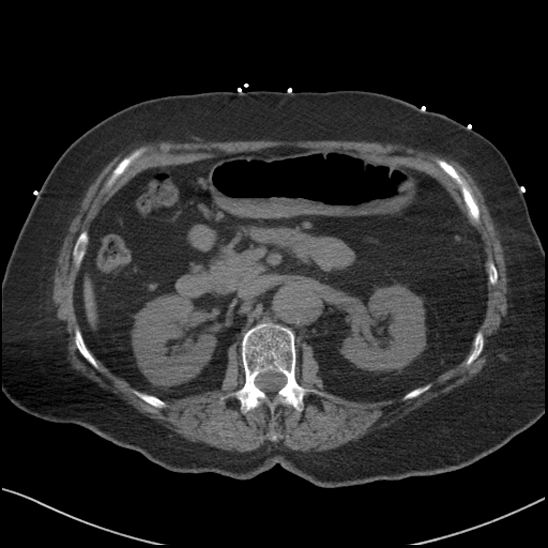 File:Aortic intramural hematoma with dissection and intramural blood pool (Radiopaedia 77373-89491 Axial non-contrast 111).jpg