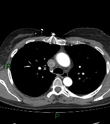 File:Aortic valve endocarditis (Radiopaedia 87209-103485 C 33).jpg