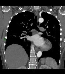 File:Aortic valve endocarditis (Radiopaedia 87209-103485 D 29).jpg