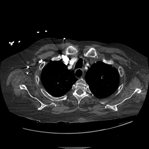 File:Aortoesophageal fistula with endovascular repair (Radiopaedia 73781-84592 Axial C+ CTPA 14).jpg
